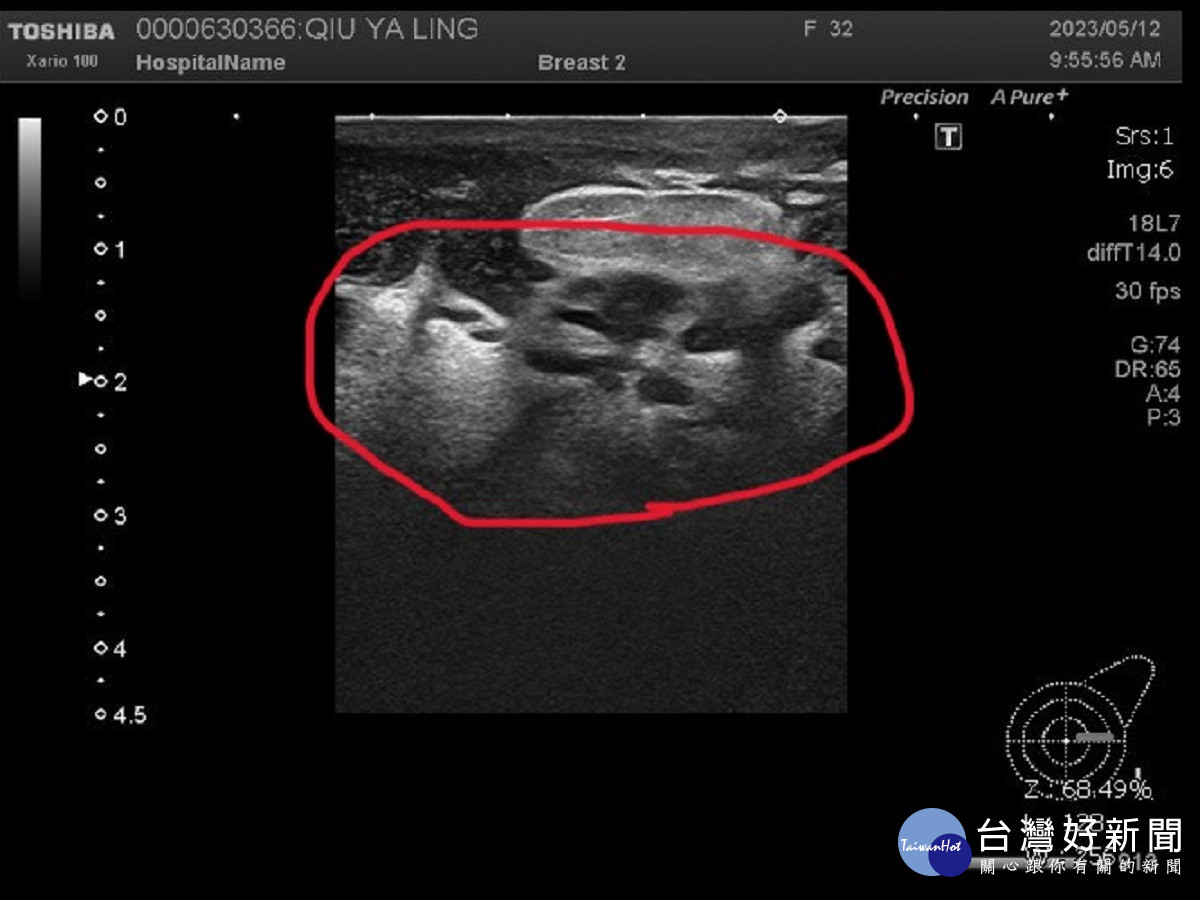 少婦乳房腫痛、潰爛憂心被切除　求助員榮醫師查出竟是罕見結核菌作崇引起