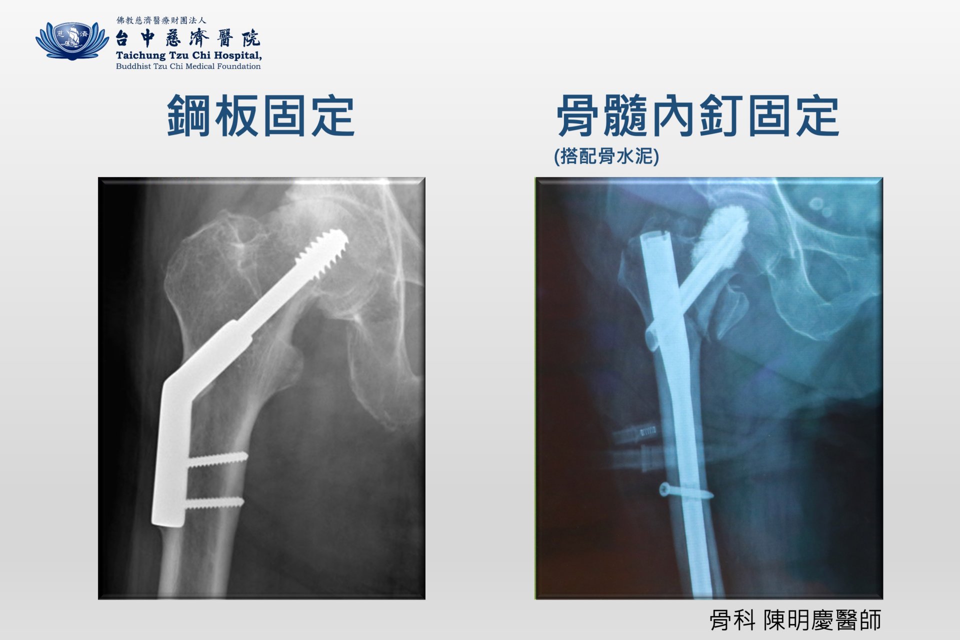 鋼板與骨髓內釘固定X光片對照。