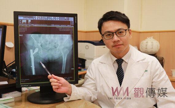 治髖部骨折有福了！微創骨髓內釘加骨水泥  健保有差額給付