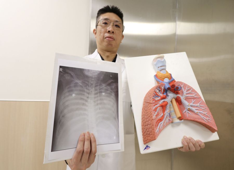 女腹痛送醫「肺臟竟消失」! 多次洗肺救回一命 254 女腹痛送醫「肺臟竟消失」! 多次洗肺救回一命 253