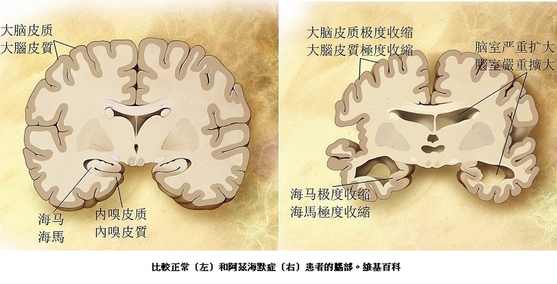 中年發福不是福 研究顯示將引發阿茲海默症