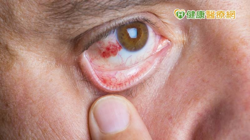 眼睛紅紅的「結膜下出血」是中風前兆? 眼科醫破解迷思