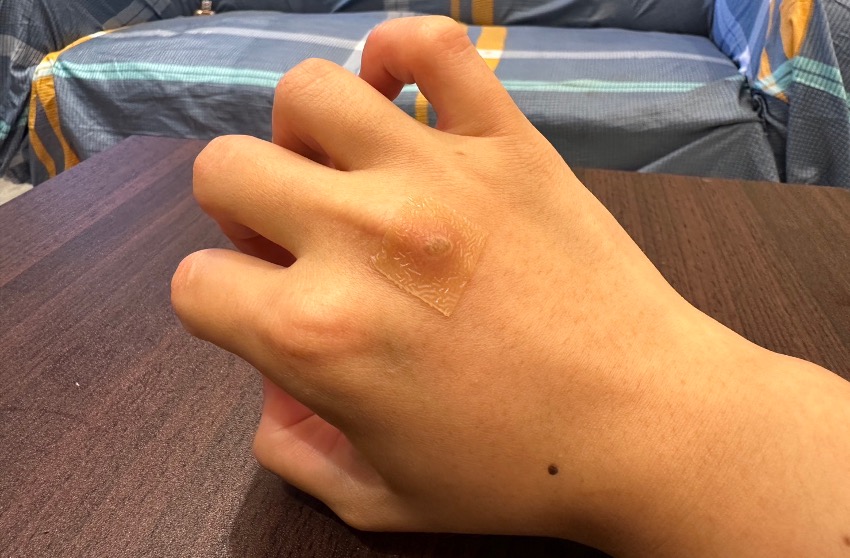 隨身準備貼身小物「人工皮」可保護傷口。(圖/康威多愛膚提供)