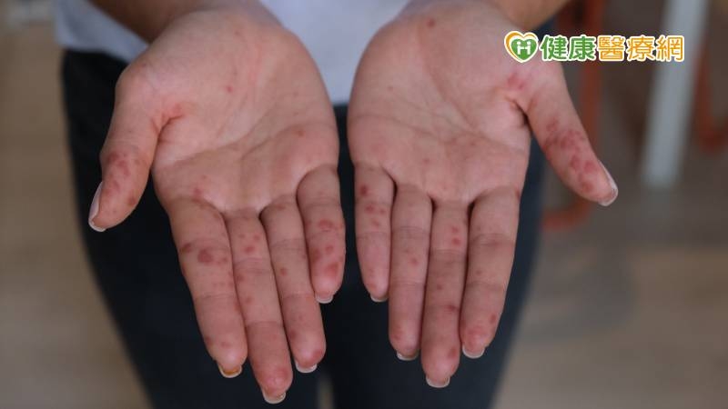 20多歲女雙手佈滿紅疹怵目驚心 竟是大人腸病毒