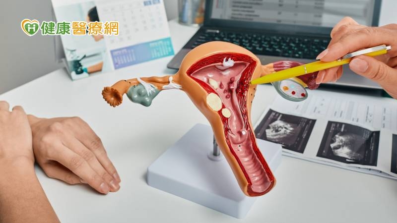 中年女子宮息肉手術3次又復發! 醫建議「1新式手術」10分鐘切除