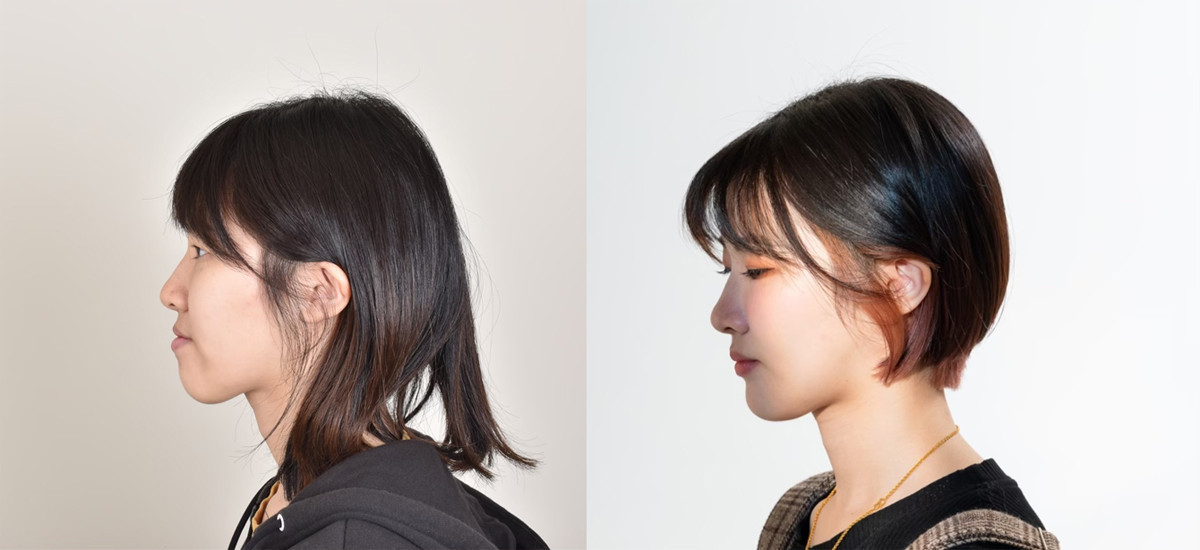 經過正顎手術後,患者的下巴輪廓獲得全方位改善。(此案例非本文當事人)