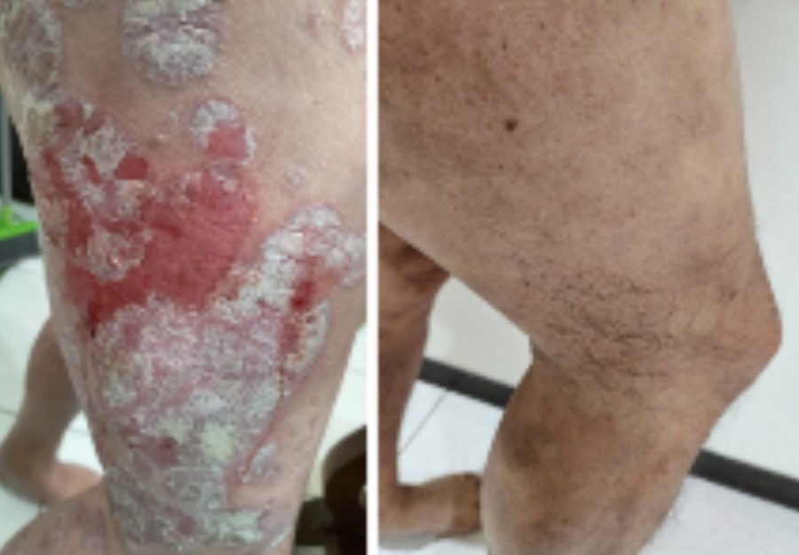 頭皮驚冒「小紅疹」竟是大毛病! 男罹乾癬慘到全身包保鮮膜才敢上床 280 頭皮驚冒「小紅疹」竟是大毛病! 男罹乾癬慘到全身包保鮮膜才敢上床 279