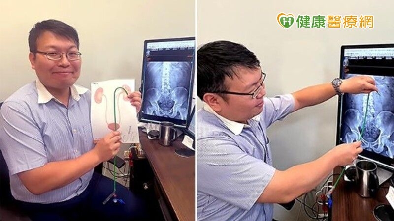 腎結石治療 8公分結石也能如吸塵器般「吸」除