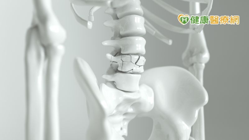 62歲洗腎女罹患骨鬆全然不知 確診時脊椎已6處骨折