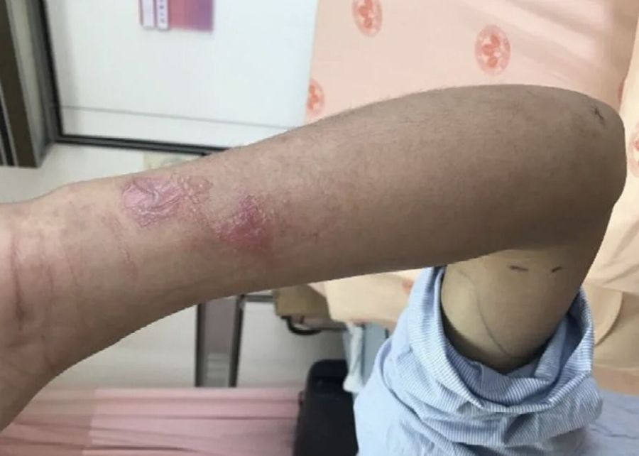 75歲翁住家遭圍攻命危 虎頭蜂多凶？北榮最新研究「20隻就要命」 249