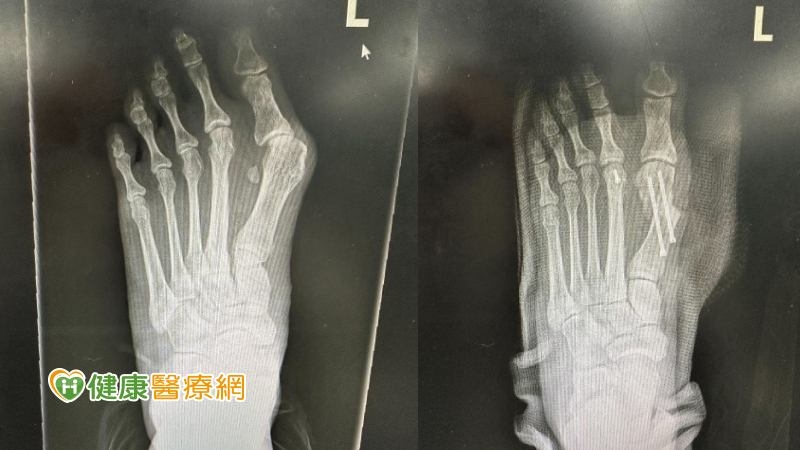 穿高跟鞋拇趾外翻近40度痛到像火在燒 未治療可能引發全身骨骼、關節問題
