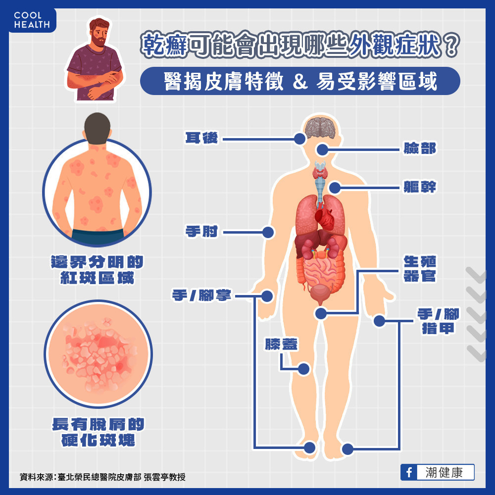 乾癬可能會出現哪些外觀症狀? 醫揭皮膚特徵、易受影響區域 乾癬可能會出現哪些外觀症狀? 醫揭皮膚特徵、易受影響區域