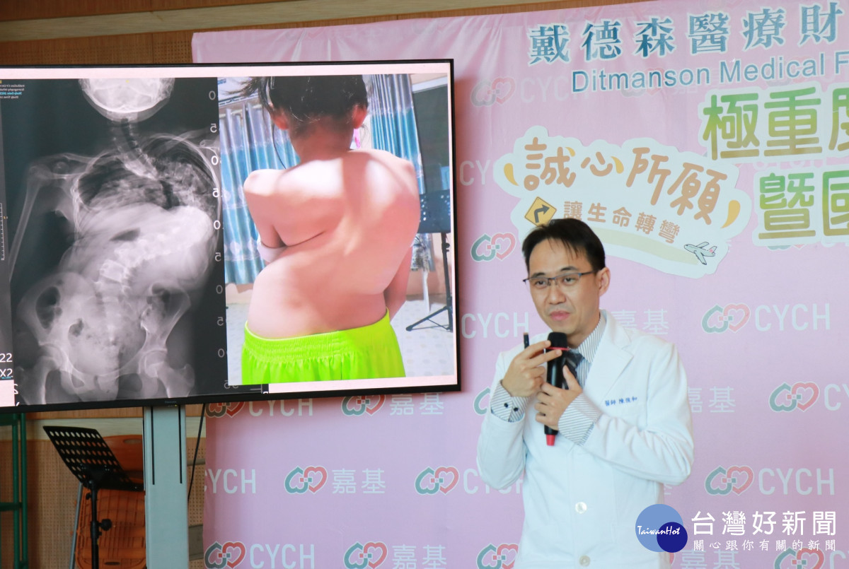 嘉基小兒骨科陳俊和醫師說明誠心脊椎側彎高達極重度的160度/嘉基醫院提供