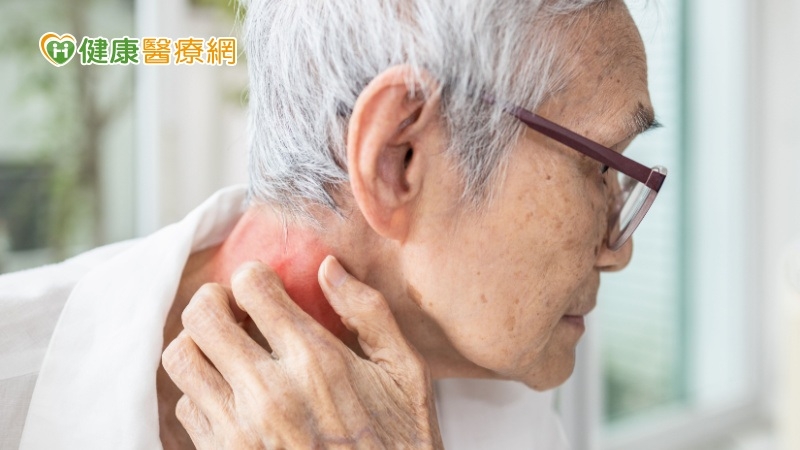 皮膚不癢不痛脫屑 就醫竟是「癌」!