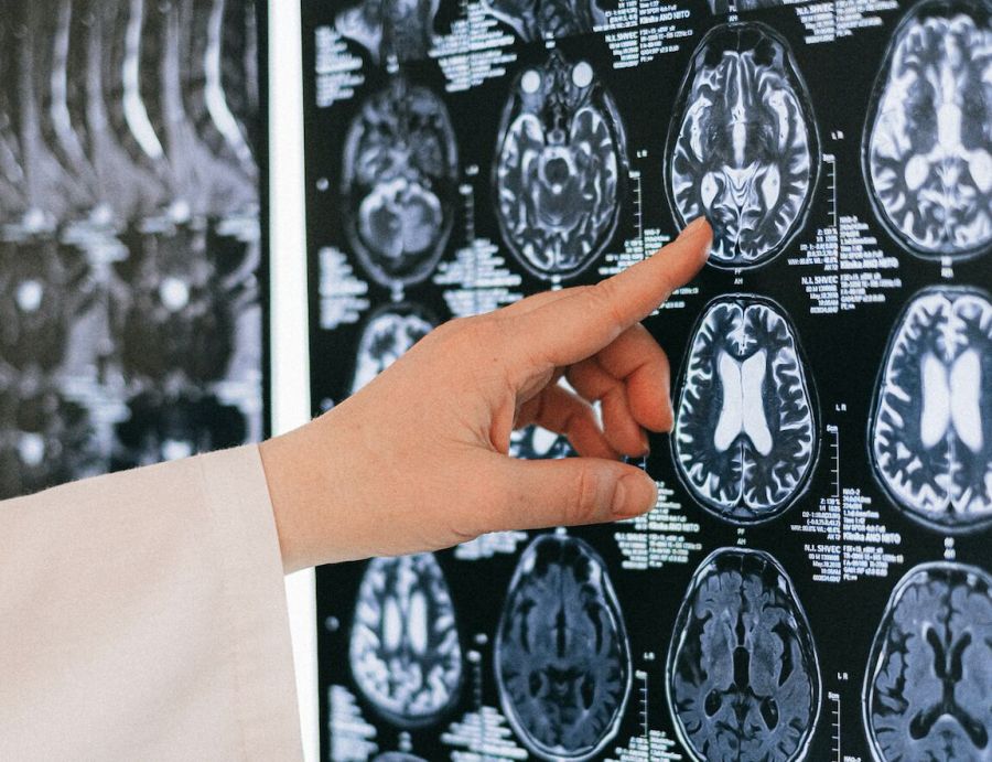 30歲台商「講話變慢、變遲鈍」竟惡性腦瘤！ 急奔回台打破早夭魔咒 257