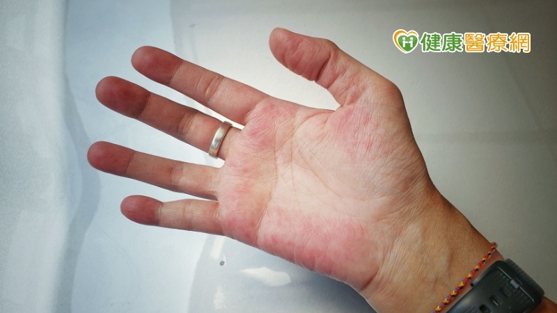 蝴蝶病「紅斑性狼瘡」典型症狀曝 致死率高常人近三倍!