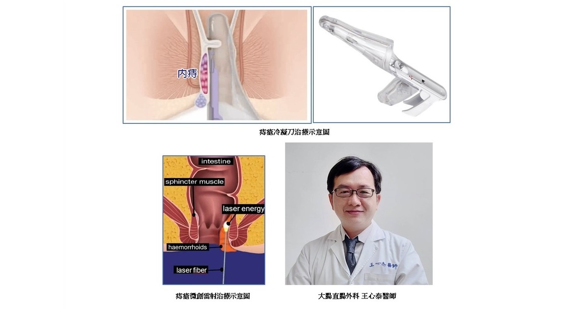 微創痔瘡治療有三寶 免住院傷口小疼痛少