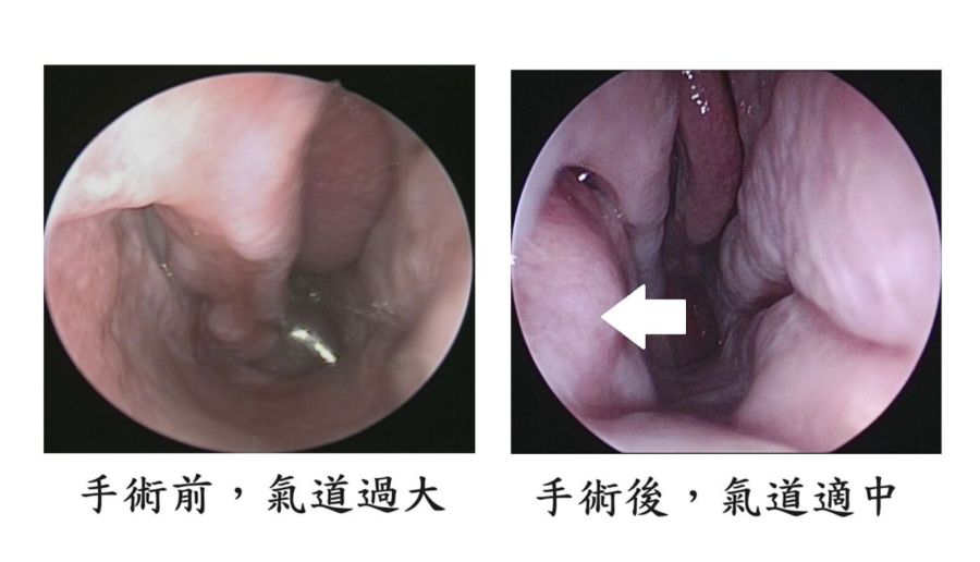鼻塞、過敏動手術越開越呼吸困難? 小心「鼻內亂流」害你變空鼻症 204 鼻塞、過敏動手術越開越呼吸困難? 小心「鼻內亂流」害你變空鼻症 203
