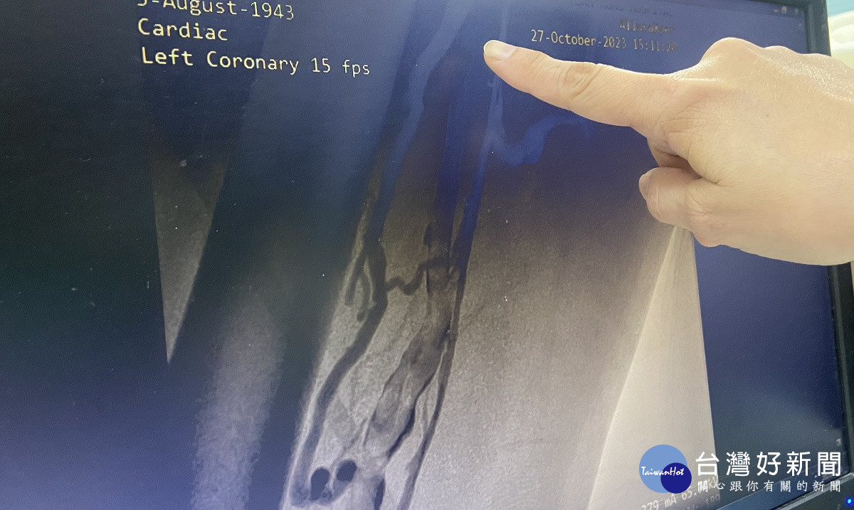八十歲老翁車禍左腿傷口無法痊癋 就醫才發現右腳靜脈幾乎全栓塞恐裁肢