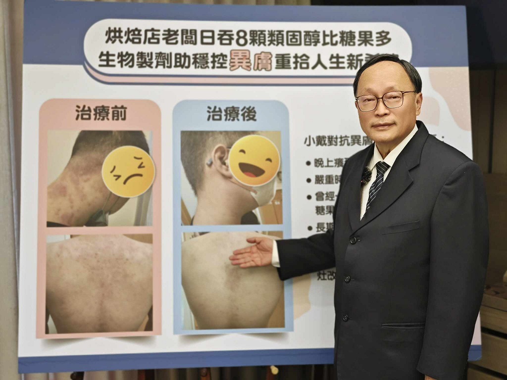 ▲院長賴寧生表示，異位性皮膚炎是一種頑固性濕疼，屬於慢性發炎、反覆發作、不具傳染性的皮膚疾病，主要因免疫細胞的發炎反應所導致。（記者林詩涵翻攝）