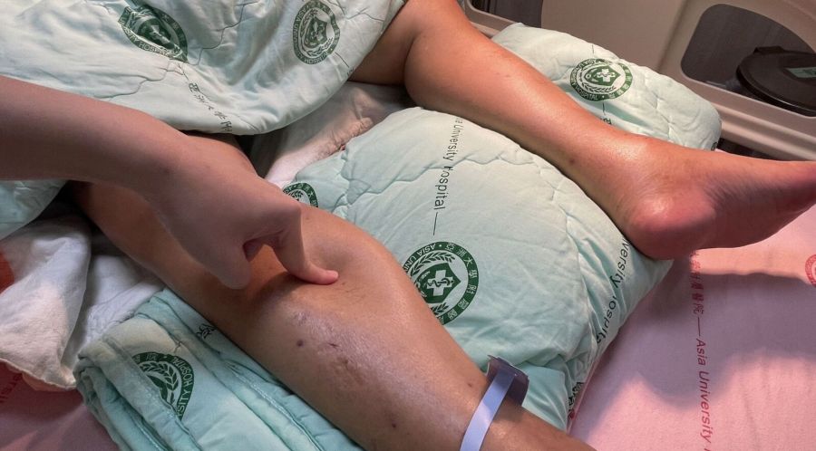 輕熟女下肢水腫又腹瀉 下一刻「性情大變」竟已爆高致死風險腦病變 224 輕熟女下肢水腫又腹瀉 下一刻「性情大變」竟已爆高致死風險腦病變 223