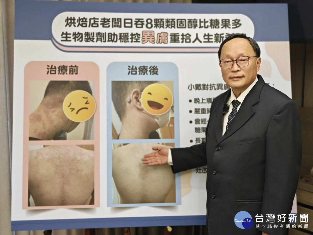院長賴寧生表示,異位性皮膚炎是一種頑固性濕疼,屬於慢性發炎、反覆發作、不具傳染性的皮膚疾病,主要因免疫細胞的發炎反應所導致/陳致愷翻攝