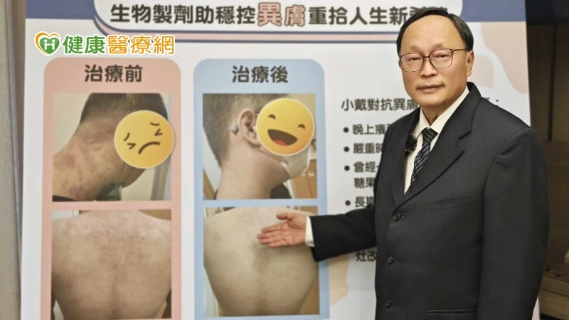 異膚抓癢床單見血! 小老闆每天吞8顆類固醇竟釀白內障