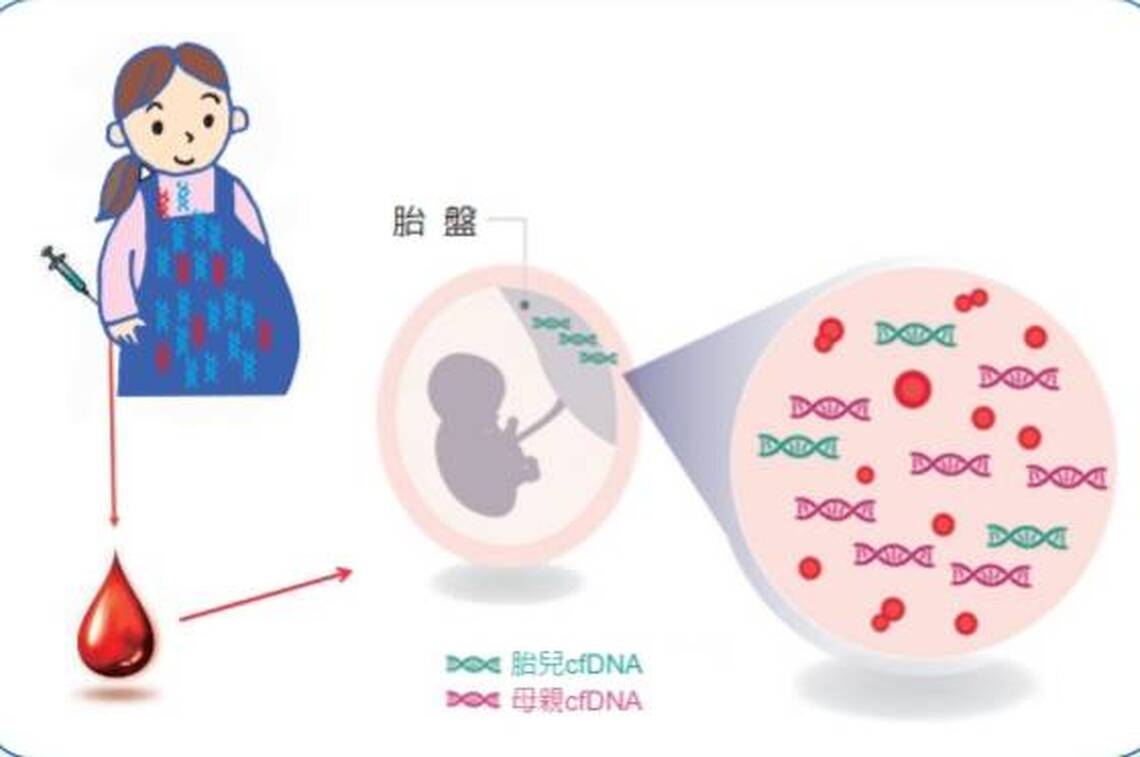 cfDNA綜合篩檢使胎兒遺傳疾病檢出率提高60.7%
