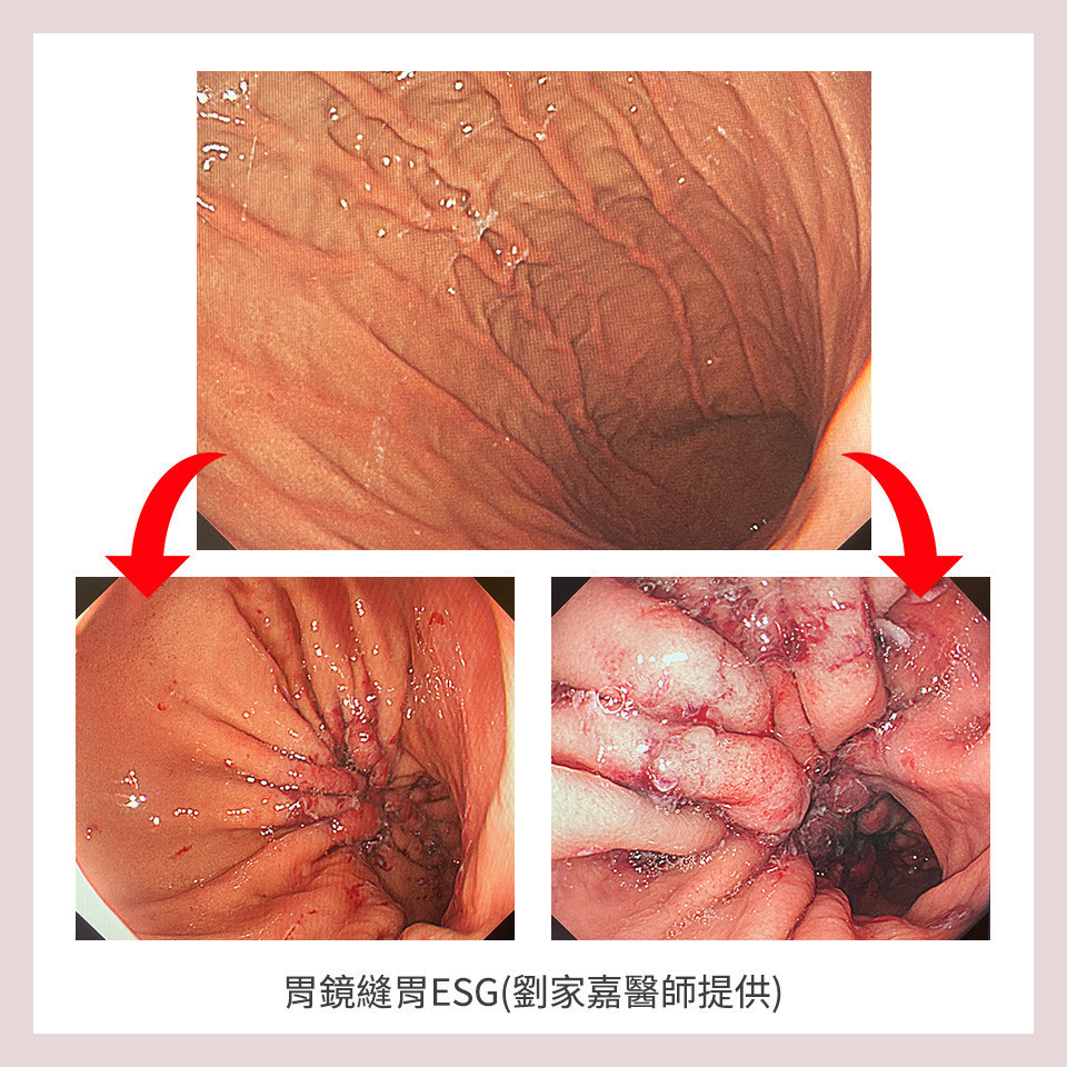 劉家嘉醫師表示,利用胃鏡從嘴巴進入胃部,把原本像囊袋一樣的胃縫成一條細管狀,減少胃部容量。