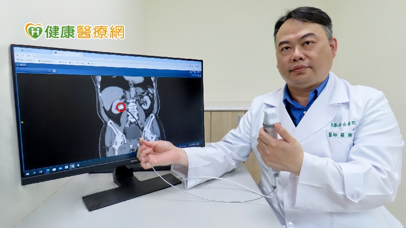 80歲阿伯無痛血尿半年 軟式輸尿管打碎結石揪病因