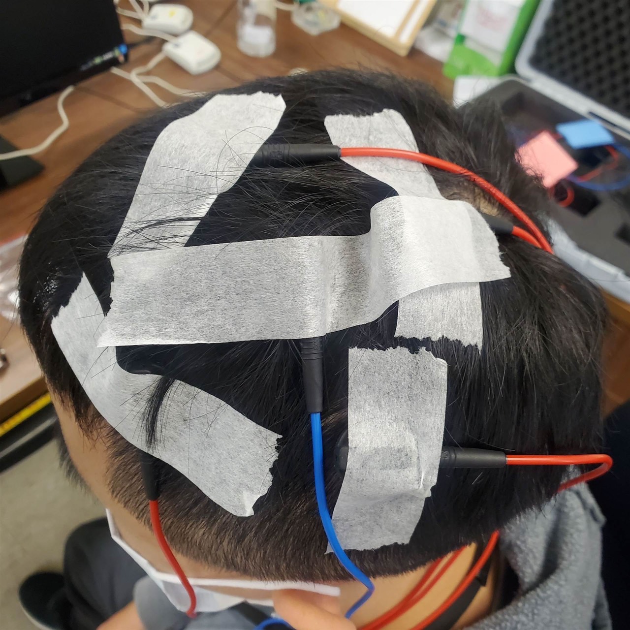 ▲「高精準經顱直流電刺激」對躁鬱症鬱期有療效（長庚提供）