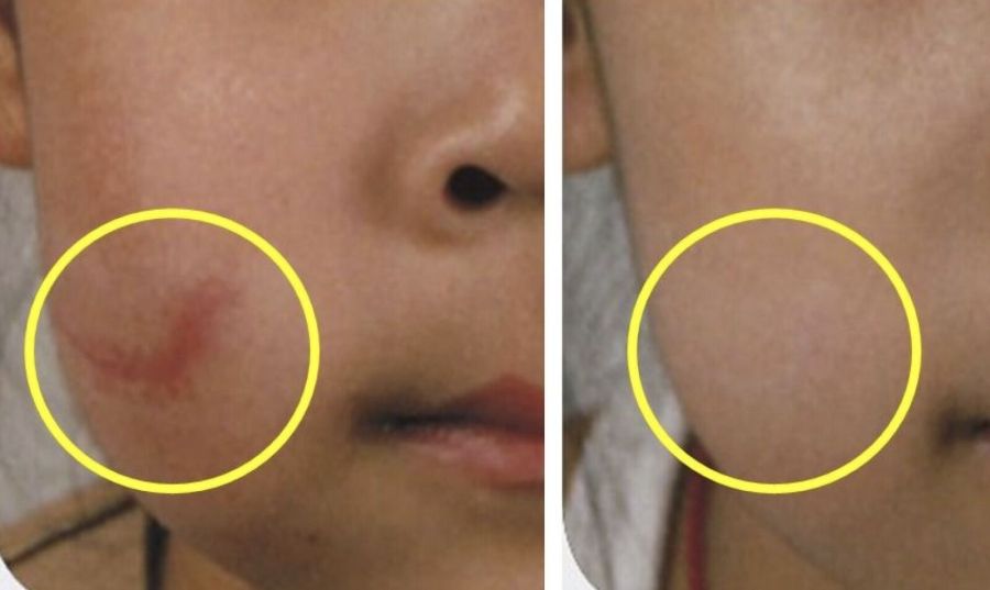 女童摔一跤臉冒「7公分紅疤」 醫出招甩掉疤痕增生!必知傷口護理秘訣 194 女童摔一跤臉冒「7公分紅疤」 醫出招甩掉疤痕增生!必知傷口護理秘訣 193