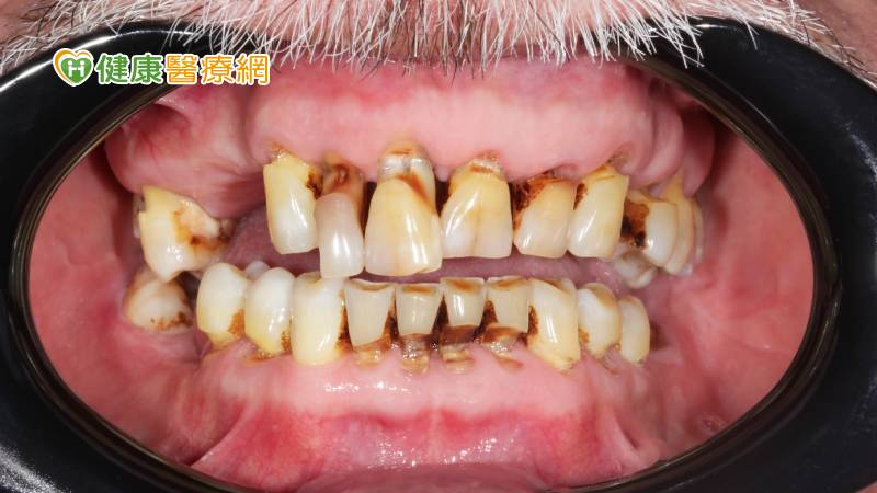 口腔不健康拖累身心 醫:牙周病患憂鬱、焦慮風險增37%