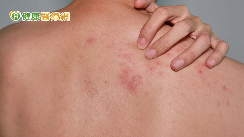 5旬男吃感冒藥皮膚剝落糜爛 禍首竟是兩週前服用的藥物