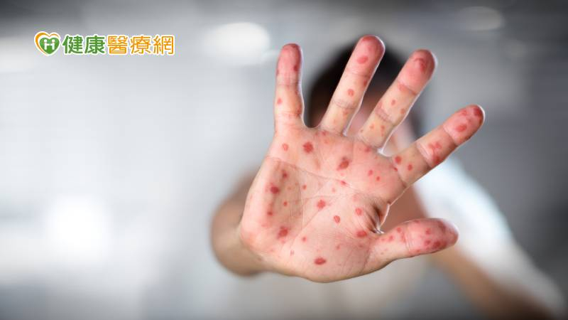 【闢謠】感染麻疹可獲抗體!? 輕忽恐釀重症與嚴重併發症
