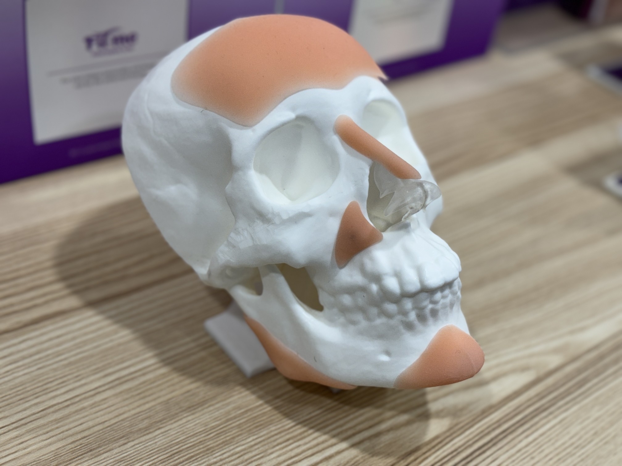 許英哲表示,3D列印有助於在假體雕刻中更細緻化,在手術時能夠更貼合臉部的骨骼組織。 許英哲表示,3D列印有助於在假體雕刻中更細緻化,在手術時能夠更貼合臉部的骨骼組織。