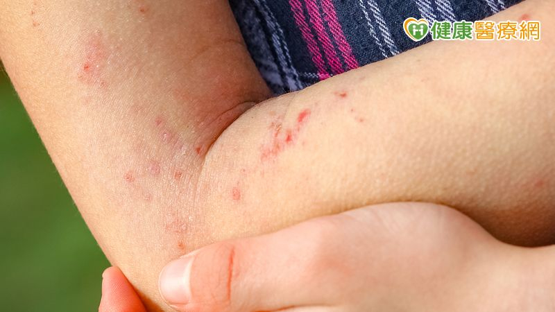 「異位性皮膚炎」狂抓恐致傷口惡化、感染! 醫教1招有效控制病況