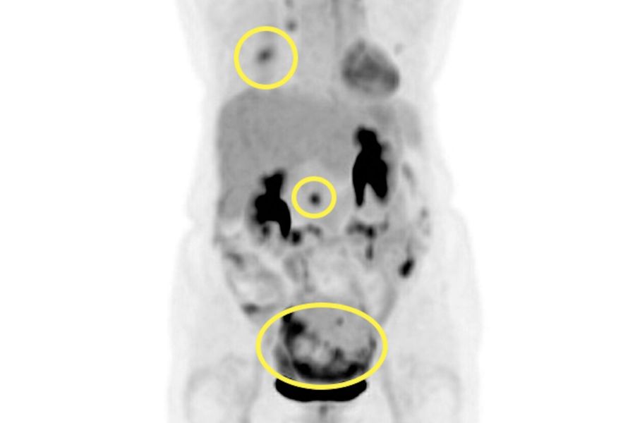 她莫名急喘送醫「肺積水全是癌細胞」 癌源頭竟來自卵巢和輸卵管 218 她莫名急喘送醫「肺積水全是癌細胞」 癌源頭竟來自卵巢和輸卵管 217