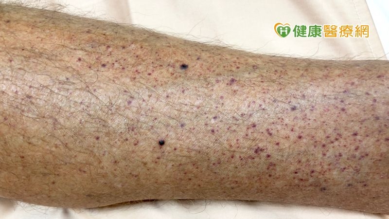 「免疫性血小板缺乏紫斑症」治療一年卻無效? 竟是鈣片惹禍!