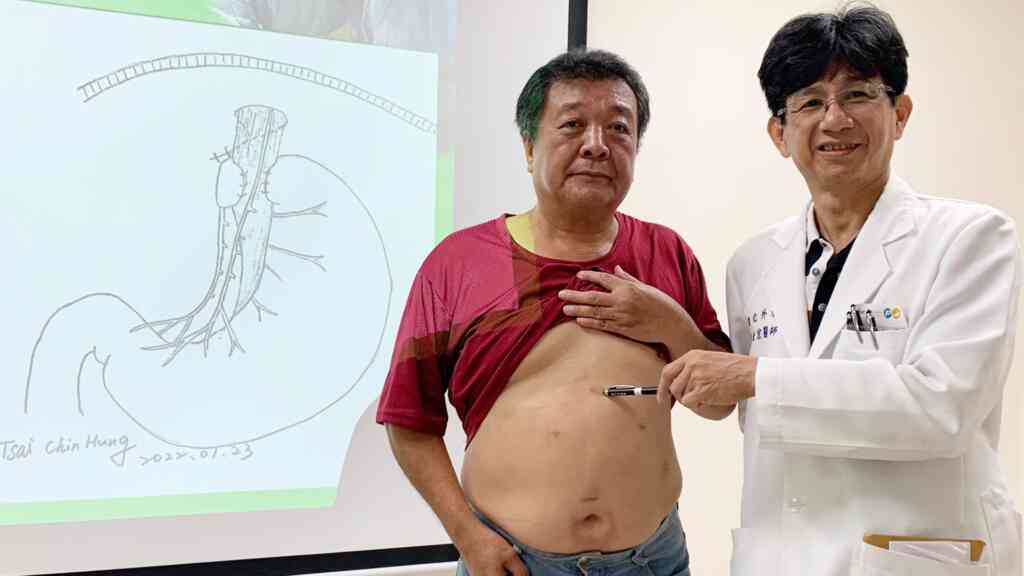 ▲台中醫院消化外科暨微創中心主蔡金宏說,陳先生到院後經檢查,確診為賁門閉鎖不全合併食道裂孔,接受「胃食道逆流微創三合一手術」,不到2小時的手術竟根治困擾他半世紀的老毛病。(台中醫院提供)