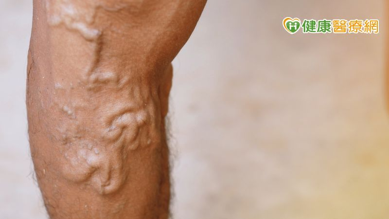 靜脈曲張腫又痛到不能走 靜脈血管「封路」找回勇腳