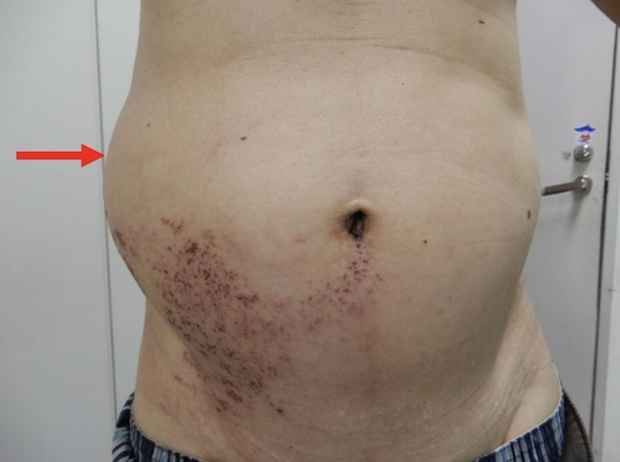 熟男「右腰鼓脹一大塊」嚇壞人 少見!染皮蛇引發腹壁肌肉鬆弛 190 熟男「右腰鼓脹一大塊」嚇壞人 少見!染皮蛇引發腹壁肌肉鬆弛 189