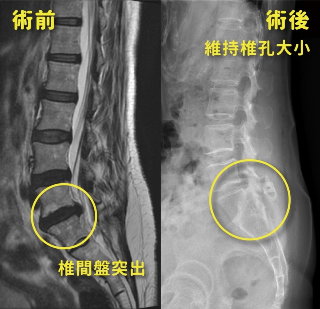 患者接受了微創椎間盤切除手術。手術後,她的症狀明顯改善,恢復了正常的行走能力,成功出院。(圖/記者林照東翻攝)