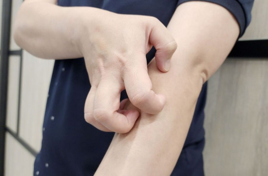 「床單上全點點血跡」 30歲女全身冒顆粒其實是結節性癢疹! 286 「床單上全點點血跡」 30歲女全身冒顆粒其實是結節性癢疹! 285