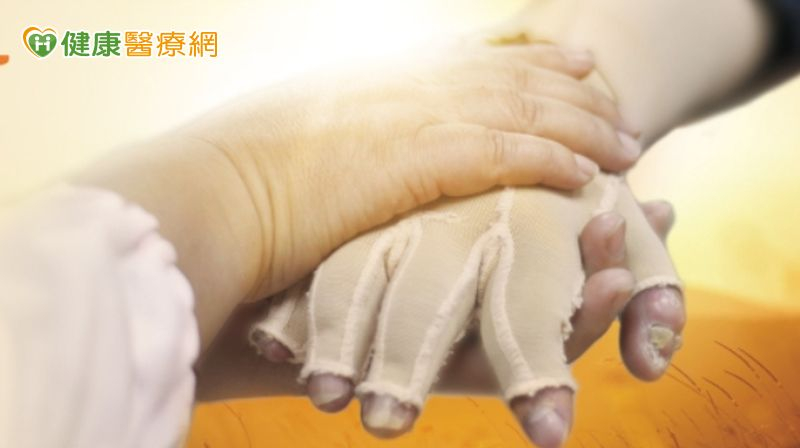 四成燒燙傷年長者未婚、離婚喪偶 陽光基金會籲捐款照護生活困境