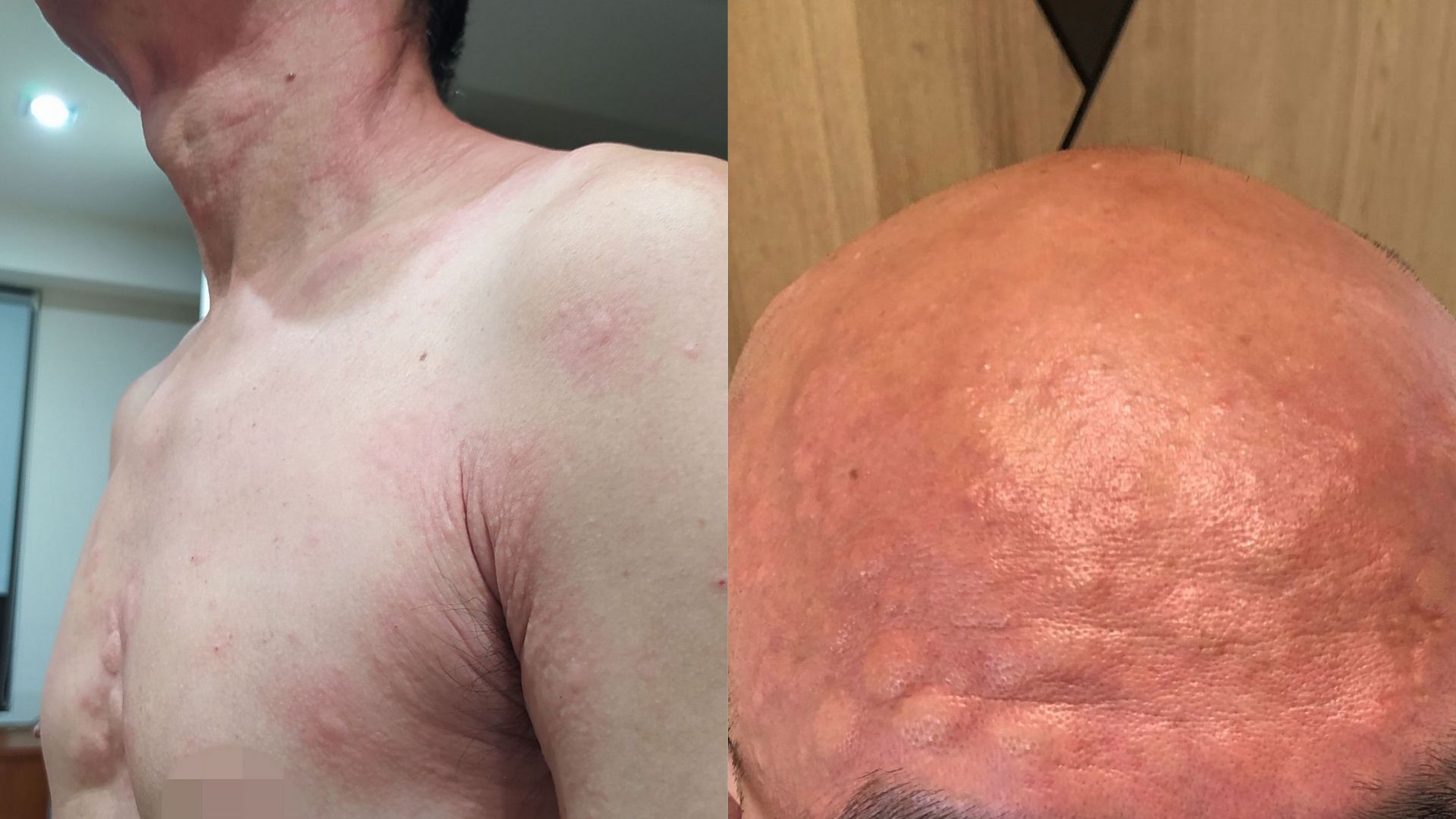 左圖:過敏水腫生在喉頭,會阻塞上呼吸道甚至可能致命。(示意圖,並非文稿內個案)<br/>右圖:因食物過敏引發皮膚斑塊。(示意圖,並非文稿內個案)