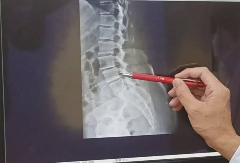 50歲女痛到寸步難行卻不敢開刀！西洋針灸助恢復工作