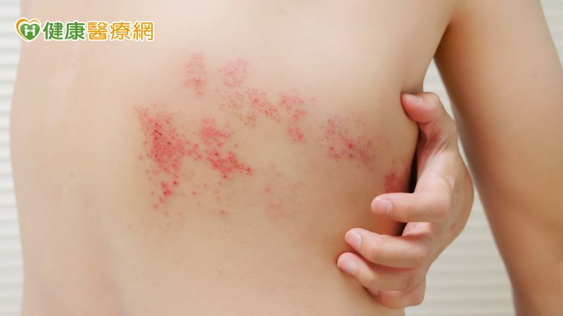 50歲以上成人請當心!皮蛇痊癒還會再復發 接種疫苗防後遺症