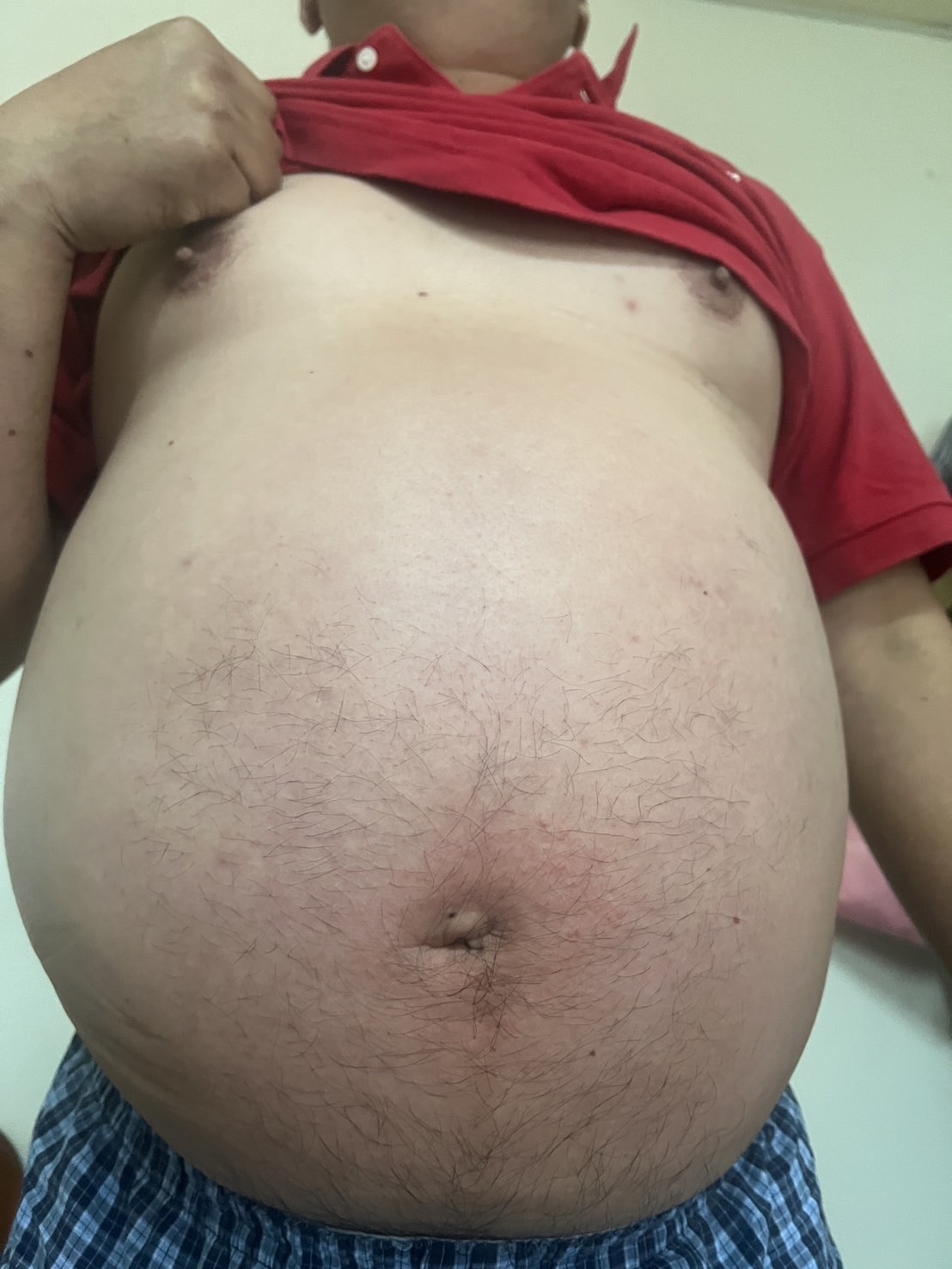 ▲男子因心臟問題，身體內的水分無法排出，肚子腫得像懷了三胞胎。（員榮醫院提供）