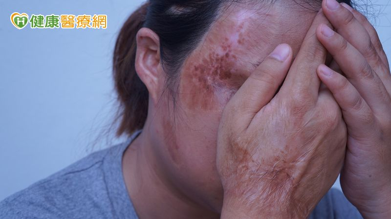 調查:逾5成顏損者面試曾遭不友善對待 陽光推「職場臉部平權行動指引」
